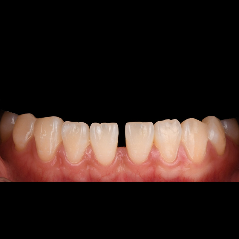 Before